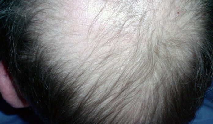Cura per la calvizie: innovazione all’Idi di Roma