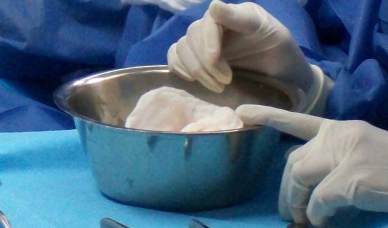 Neonata morta subito dopo il parto