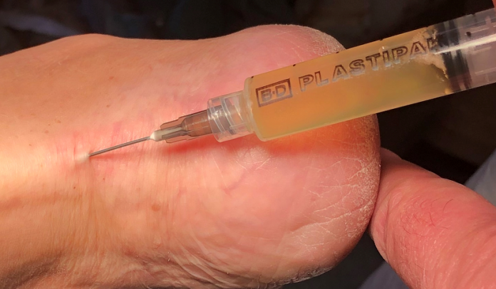 fascite plantare cronica