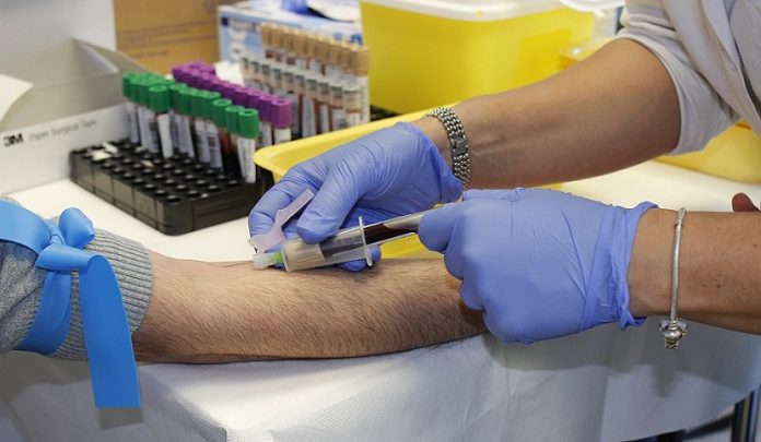 malattia di parkinson