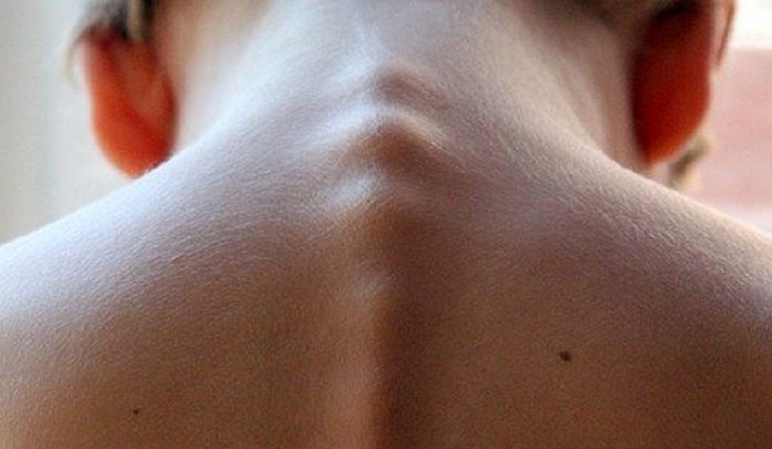 muscoli della colonna