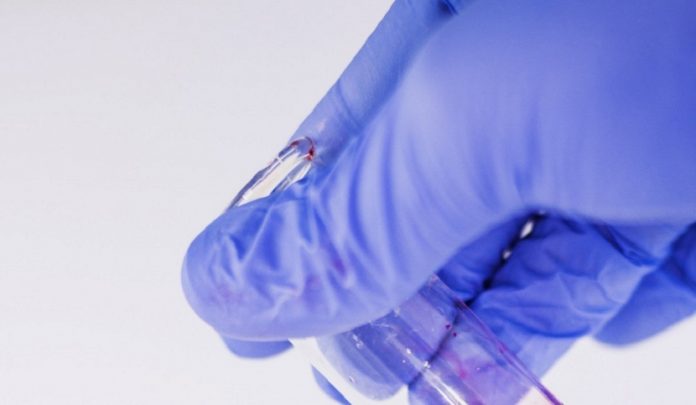 contrazione del virus hcv