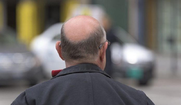 autotrapianto di capelli