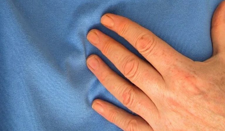 coronarografia effettuata in ritardo