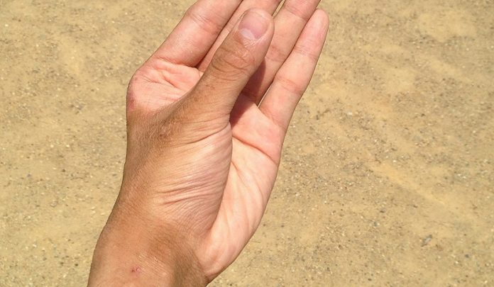errata diagnosi di frattura dello scafoide