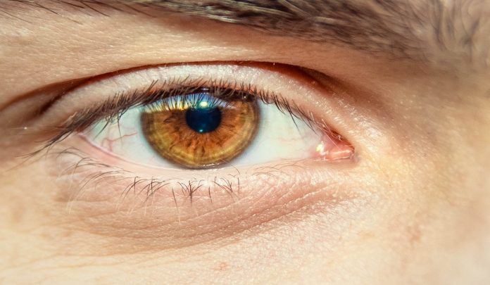 Glaucoma acuto occhio sinistro ed errate tempestive terapie