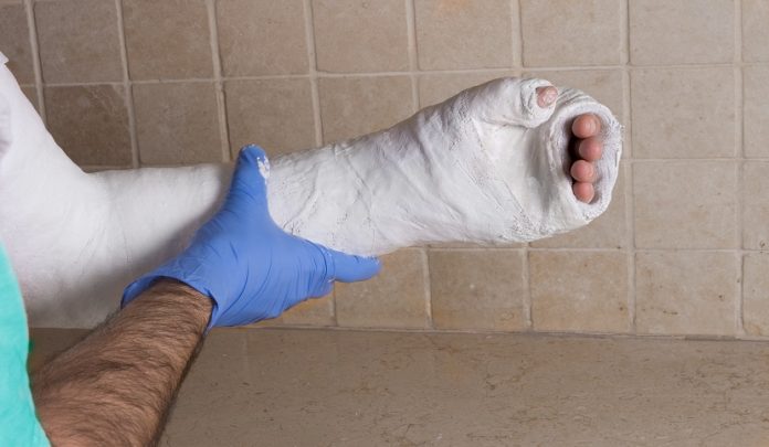 Orthopedic,Technician,Putting,On,A,Fiberglass,/,Plaster,Cast,On Frattura al gomito sinistro ed errata applicazione di gessatura