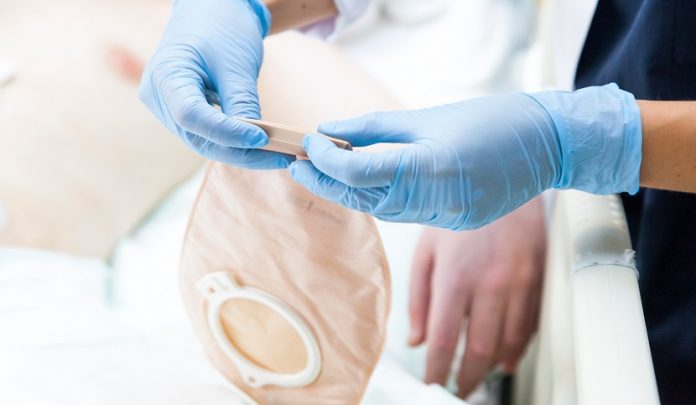 Intervento di colostomia non necessario e provocato da errata diagnosi