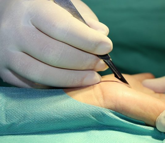 Parestesie del nervo ulnare a seguito di intervento alla mano