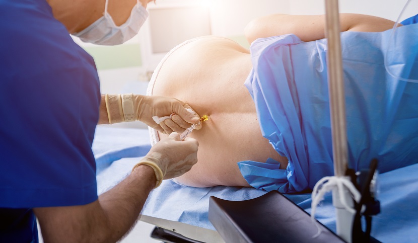 Anestesia epidurale e conseguente decesso della paziente
