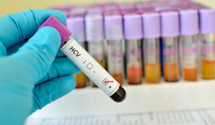 positività-hcv