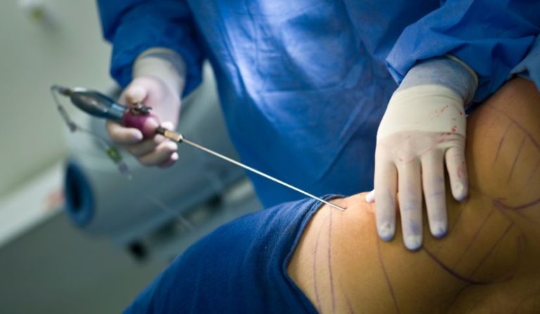 chirurgia-estetica-liposuzione