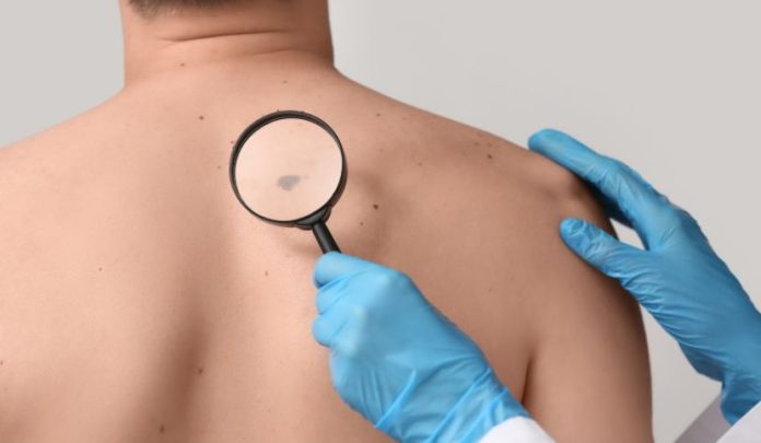 diagnosi-tardiva-melanoma diagnosi-tardiva-melanoma